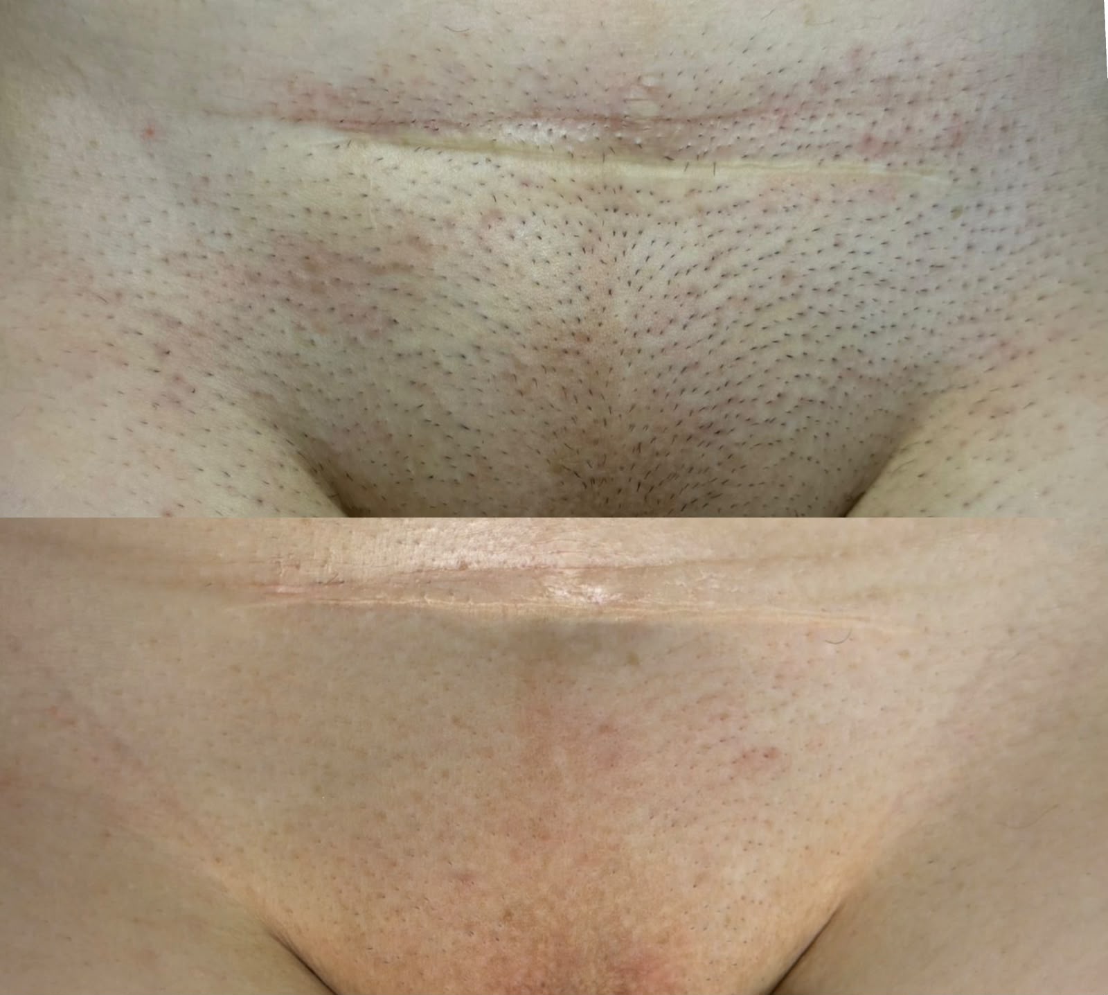 Resultado Laser